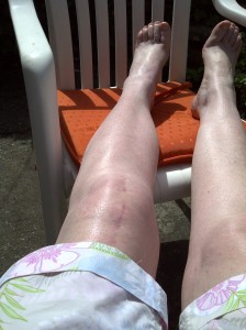 Having a rest - and fresh air for my knee between tape applications