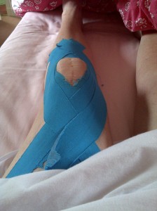 My physio put this tape on, to show me how to do it.